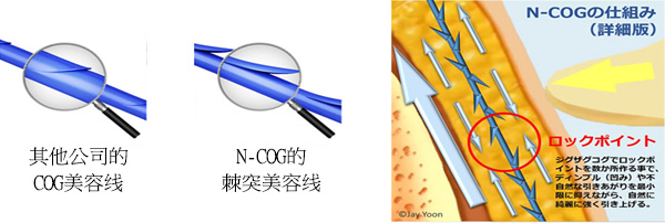 N-COG的棘突美容线