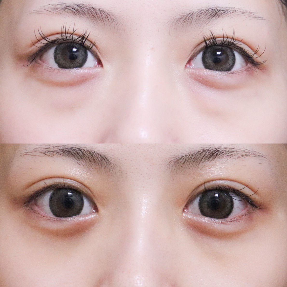 経結膜脱脂法（目の下の脂肪除去）の症例写真