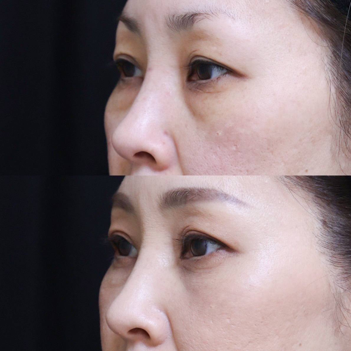 経結膜脱脂法（目の下の脂肪除去）の症例写真