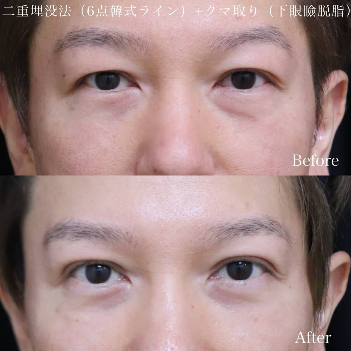 二重埋没（6点韓式埋没法）＋クマ取り（下眼瞼脱脂）