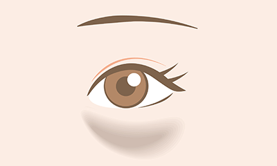 目の下脂肪除去（経結膜脱脂術）