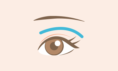 目の上脂肪除去（上眼瞼脱脂法）