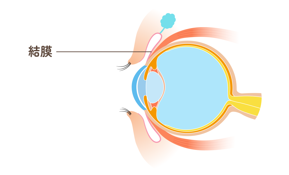 アレルギー性結膜炎とは