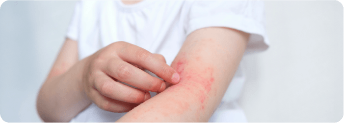 アトピー性皮膚炎