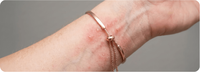 金属アレルギー