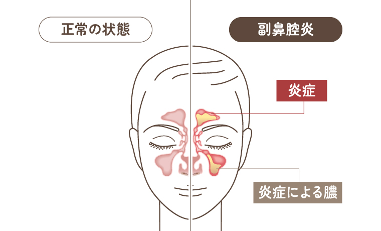 副鼻腔炎の症状