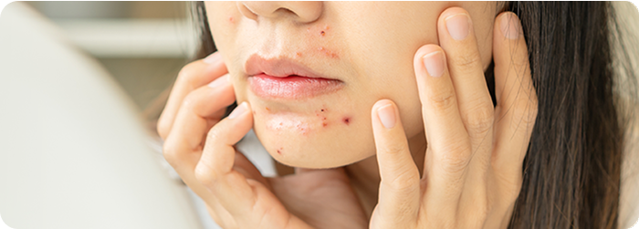 にきび（尋常性ざ瘡）