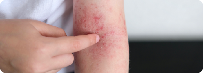 アトピー性皮膚炎