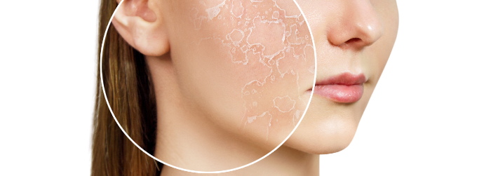 乾燥肌・肌荒れ