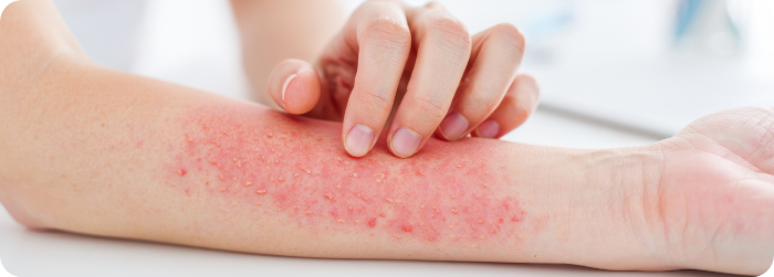 接触性皮膚炎（かぶれ）