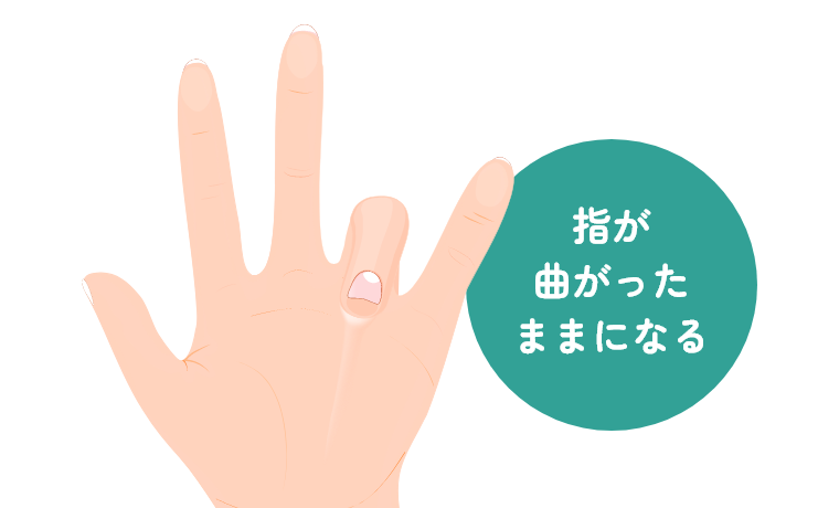 デュピュイトラン拘縮とは