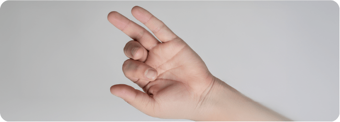 デュピュイトラン拘縮