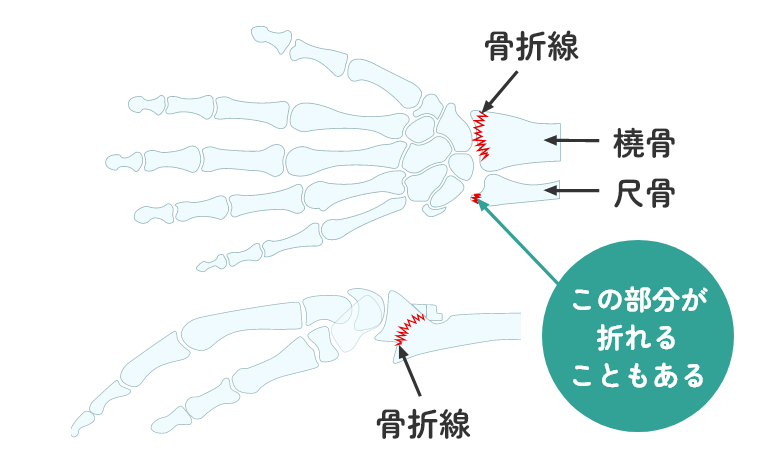 橈骨遠位端骨折・尺骨遠位端骨折とは