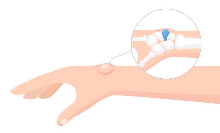 ガングリオンとは