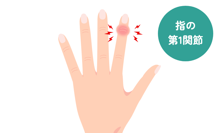 ヘバーデン結節とは