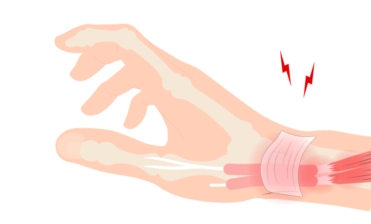 ドケルバン腱鞘炎とは