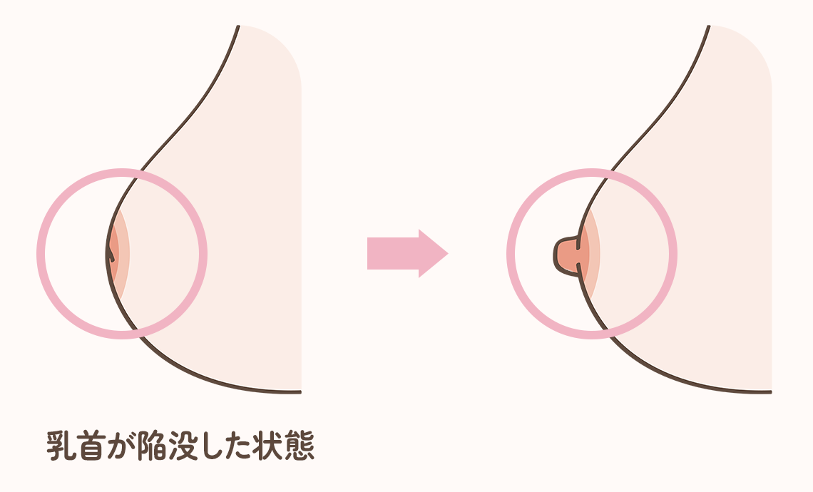 陥没乳頭とは