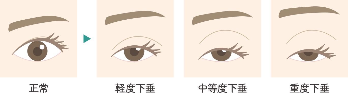 眼瞼下垂のイラスト