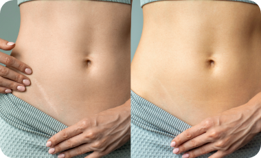 完全に消すことは難しく、「より目立たなくする」ことが目的