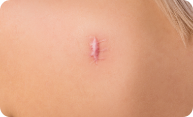 体質によって再発することもある（特にケロイド）