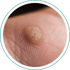 肥厚性瘢痕（ひこうせいはんこん）