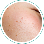 扁平疣贅（へんぺいゆうぜい）	