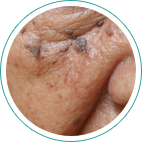 脂漏性角化症（老人性いぼ）