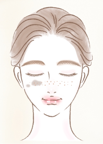 しみ・そばかす