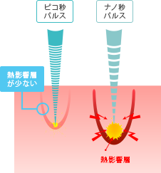 ピコ秒パルス ナノ秒パルス 熱影響層が少ない 熱影響層