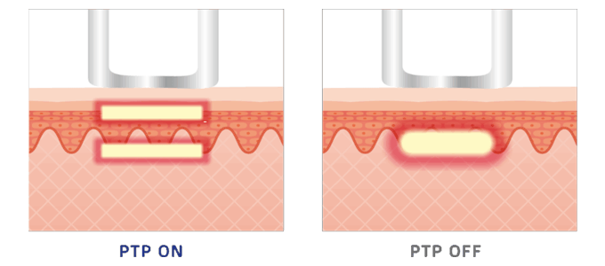 「RICH-PTP」モードで刺激・痛みを軽減