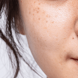 PTPトーニング(トライビーム)はこのような方におすすめ