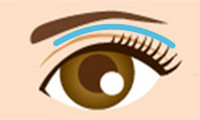 上眼瞼脱脂法（目の上の脂肪除去）