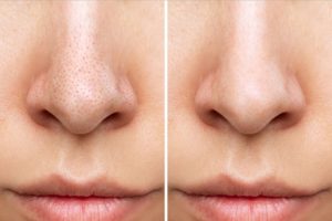 いちご鼻は美容皮膚科の施術で改善できる