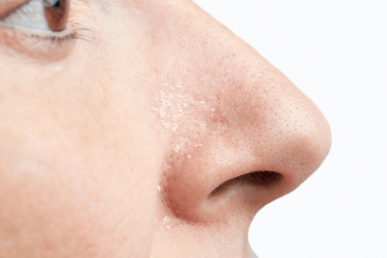 鼻の黒ずみタイプ・原因を診断