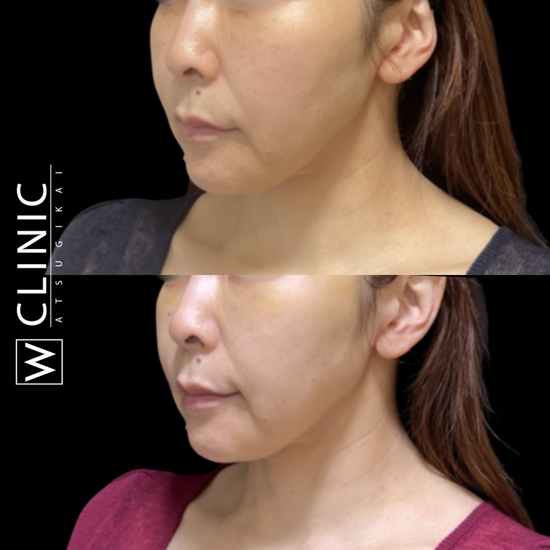 アッティバ 全顔 施術前