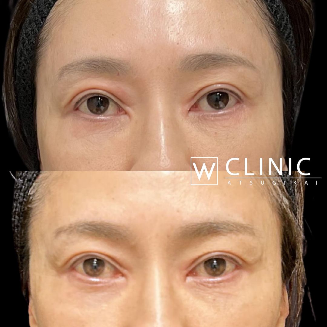 アッティバ 上瞼+下瞼