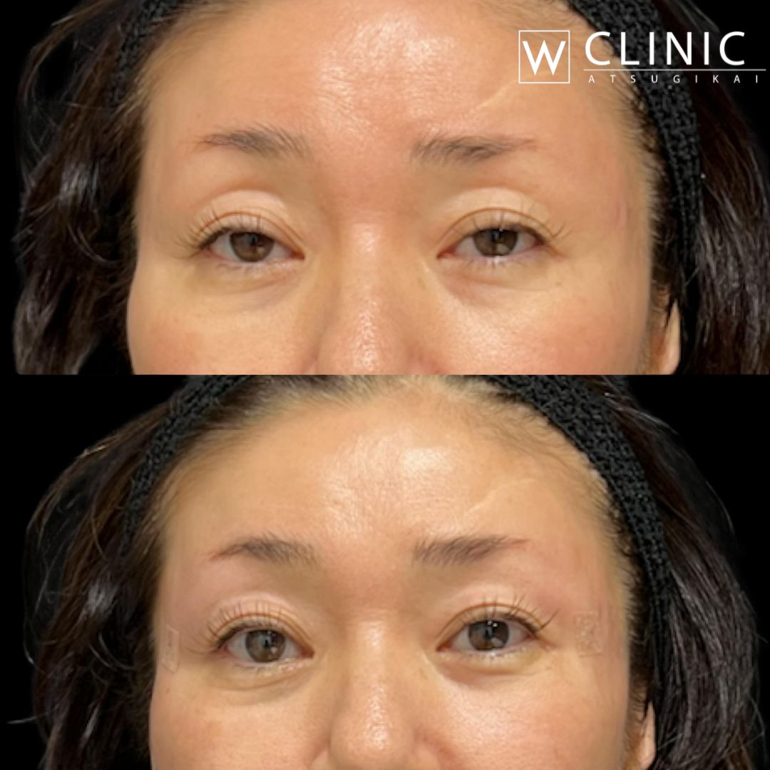 アッティバ 上瞼 施術前