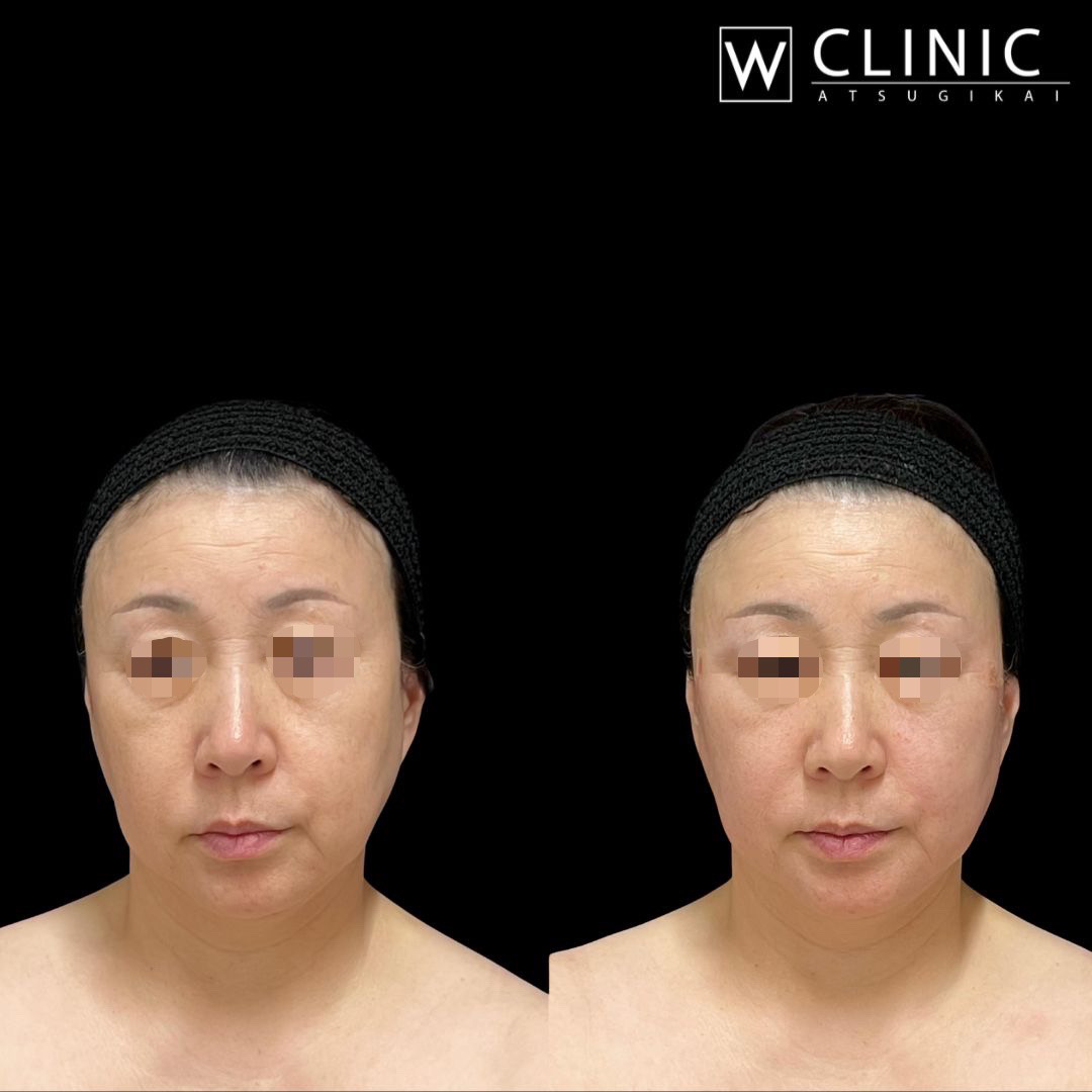 アッティバ 全顔 施術前