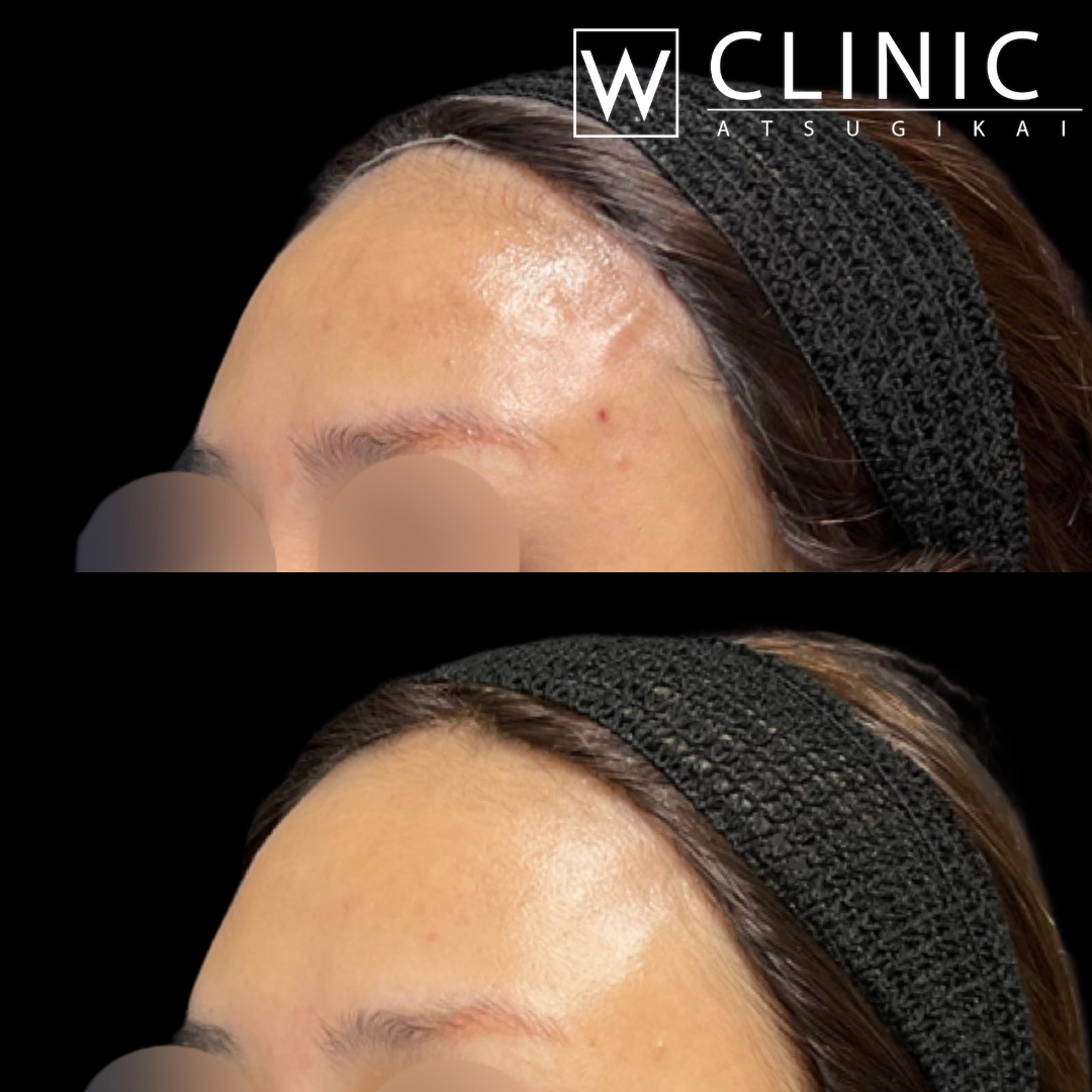 額のヒアルロン酸 施術前