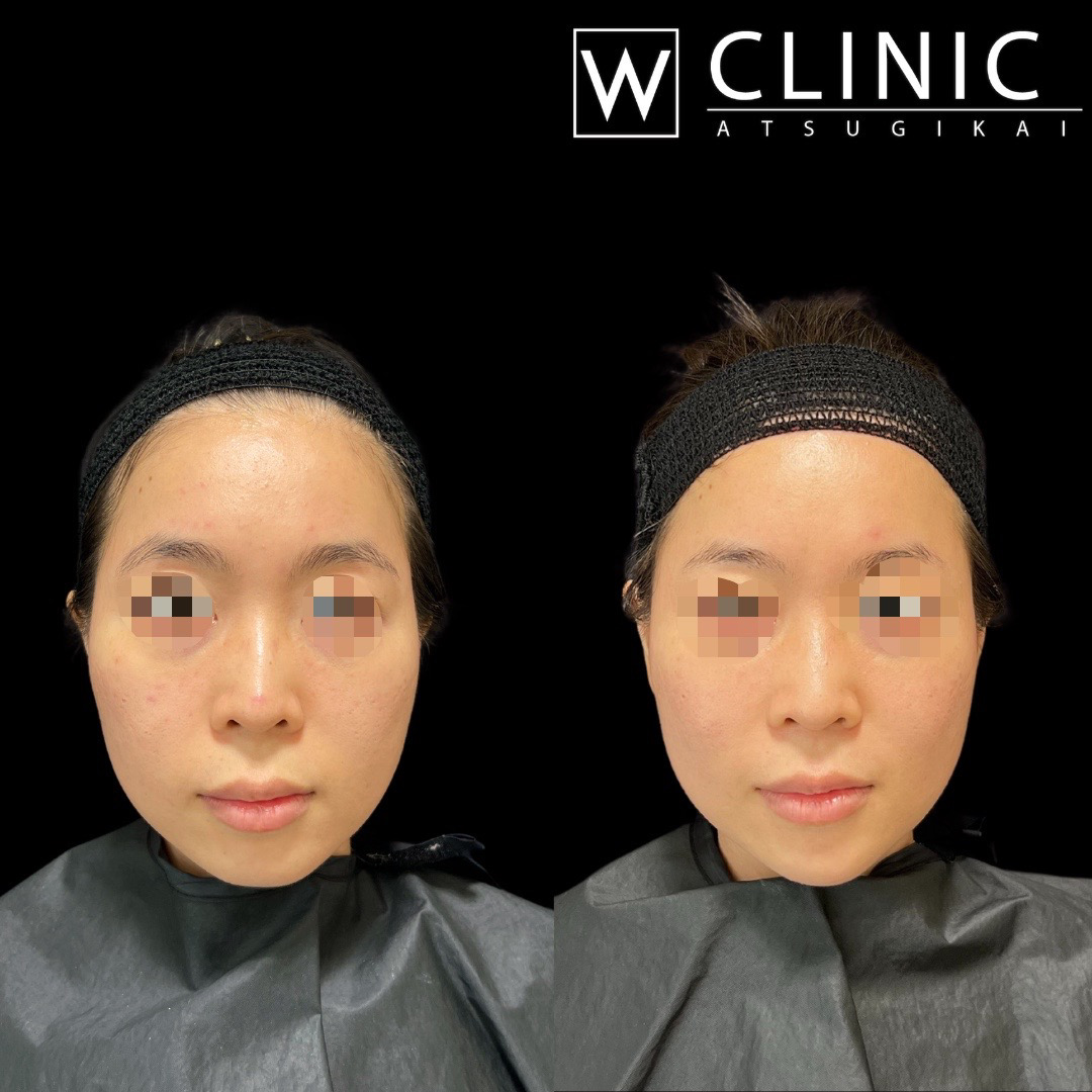 顎のヒアルロン酸 施術前