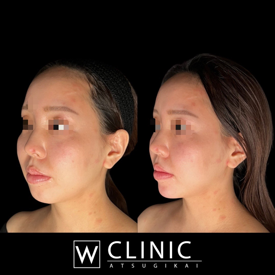 顎のヒアルロン酸