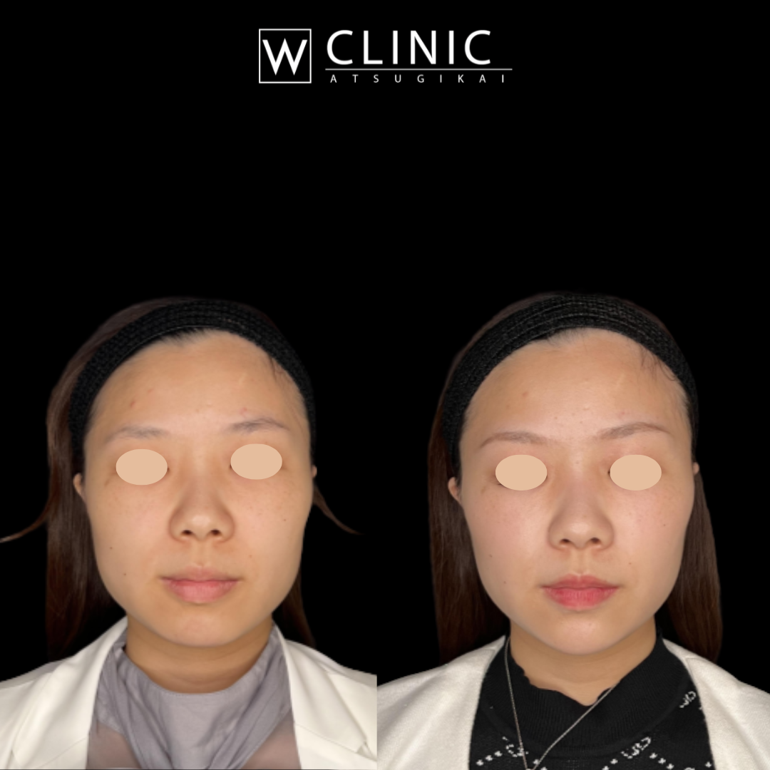 顎のヒアルロン酸 施術前