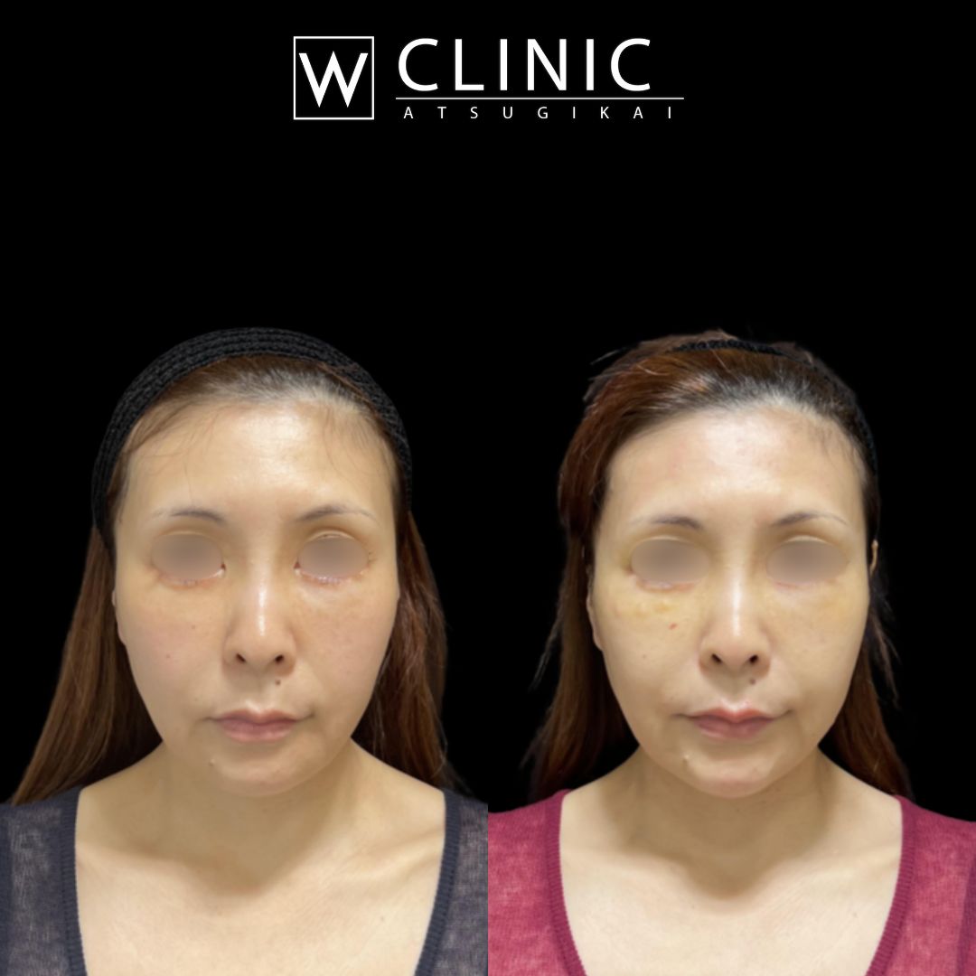 アッティバ 全顔 施術直後