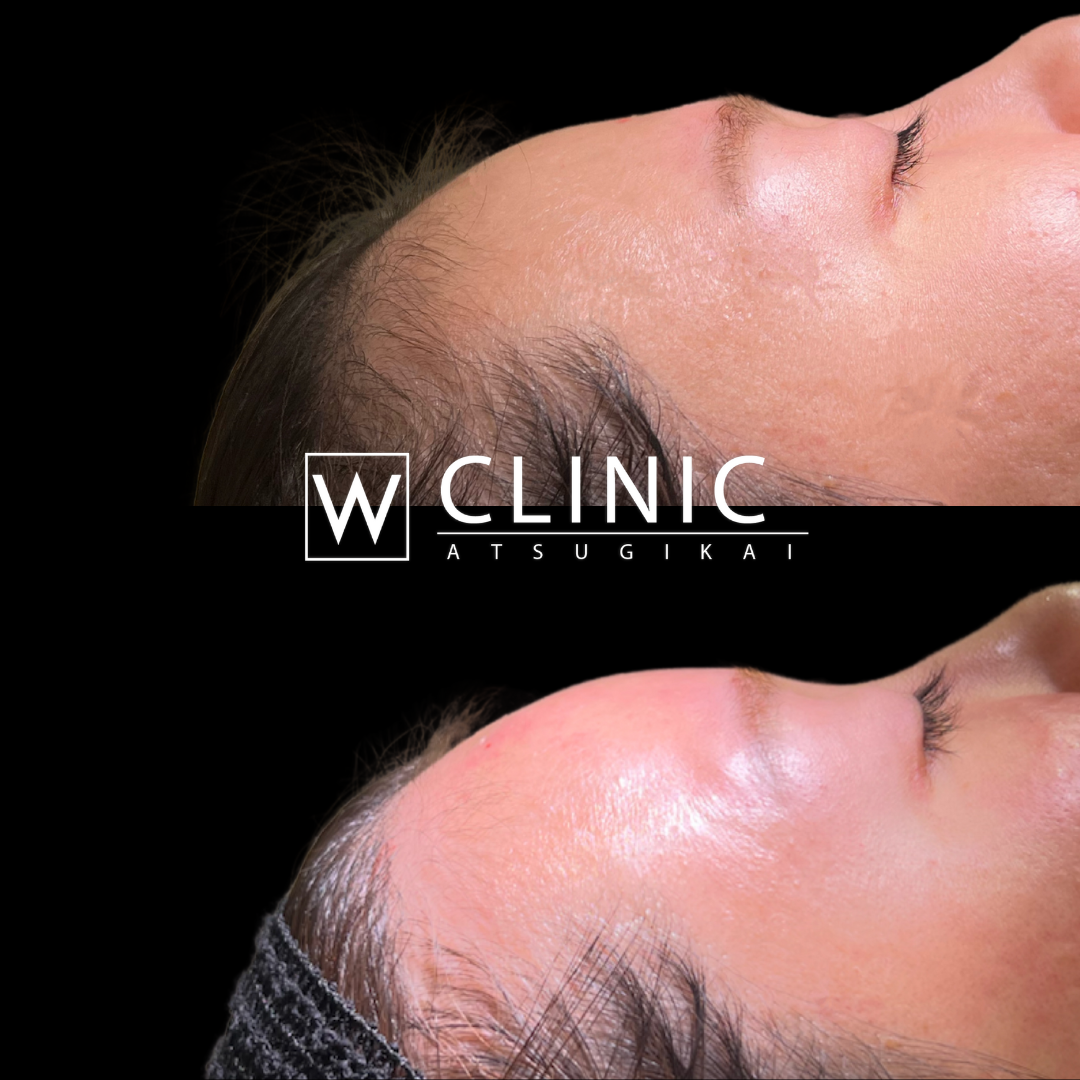 額のヒアルロン酸 施術後