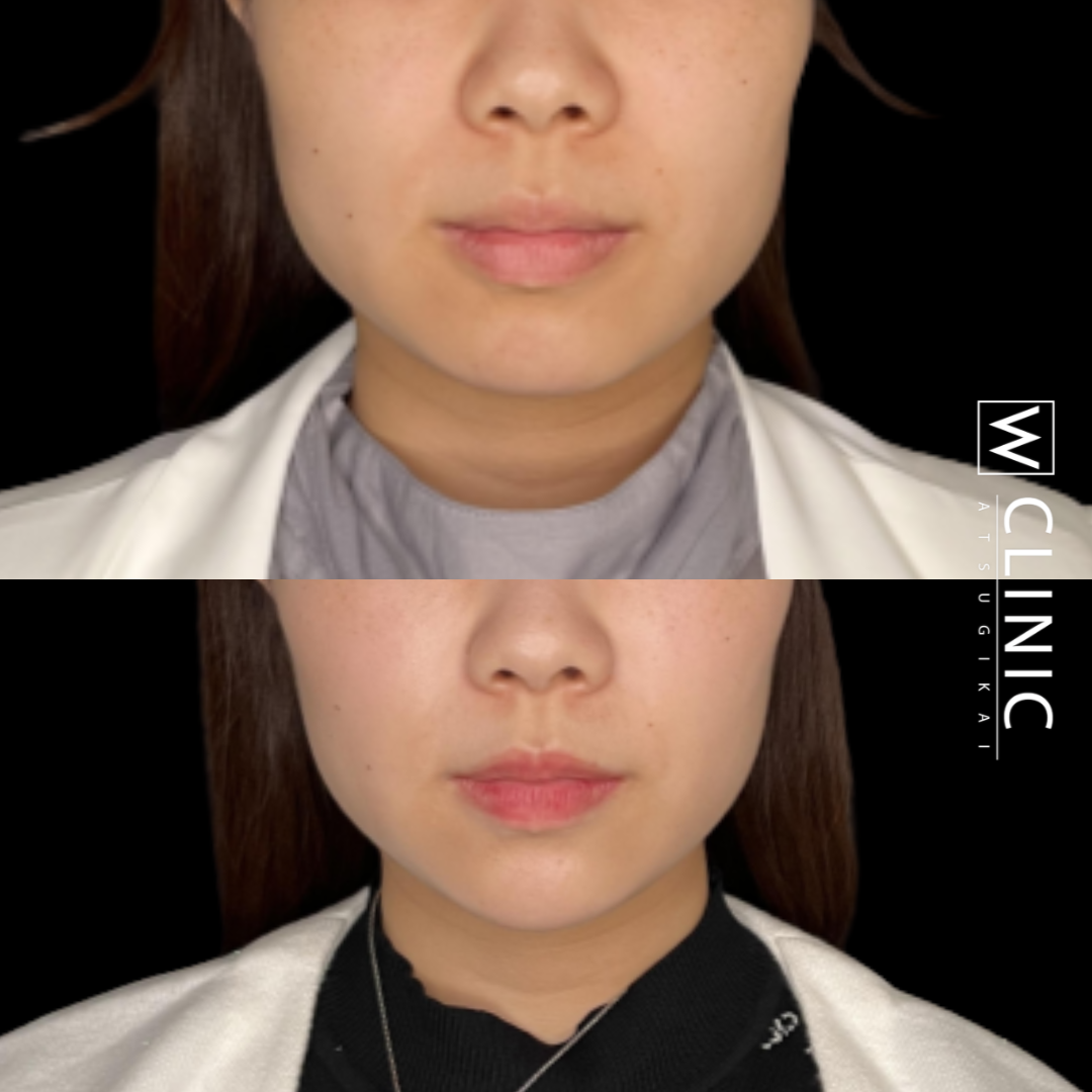 顎のヒアルロン酸 施術2週間後
