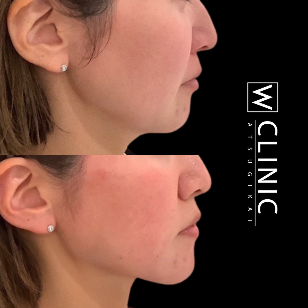 顎のヒアルロン酸