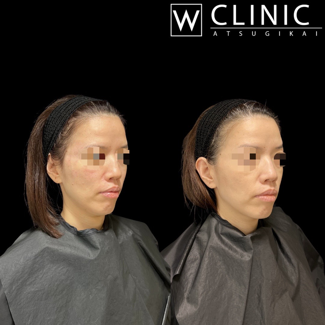 顎のヒアルロン酸 施術直後