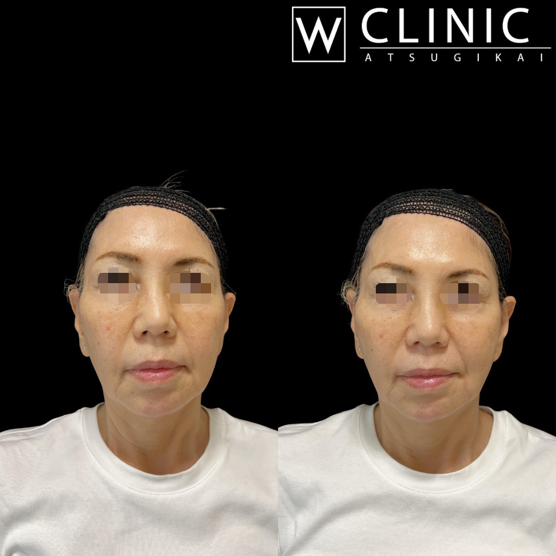 リフトアップヒアルロン酸 施術前