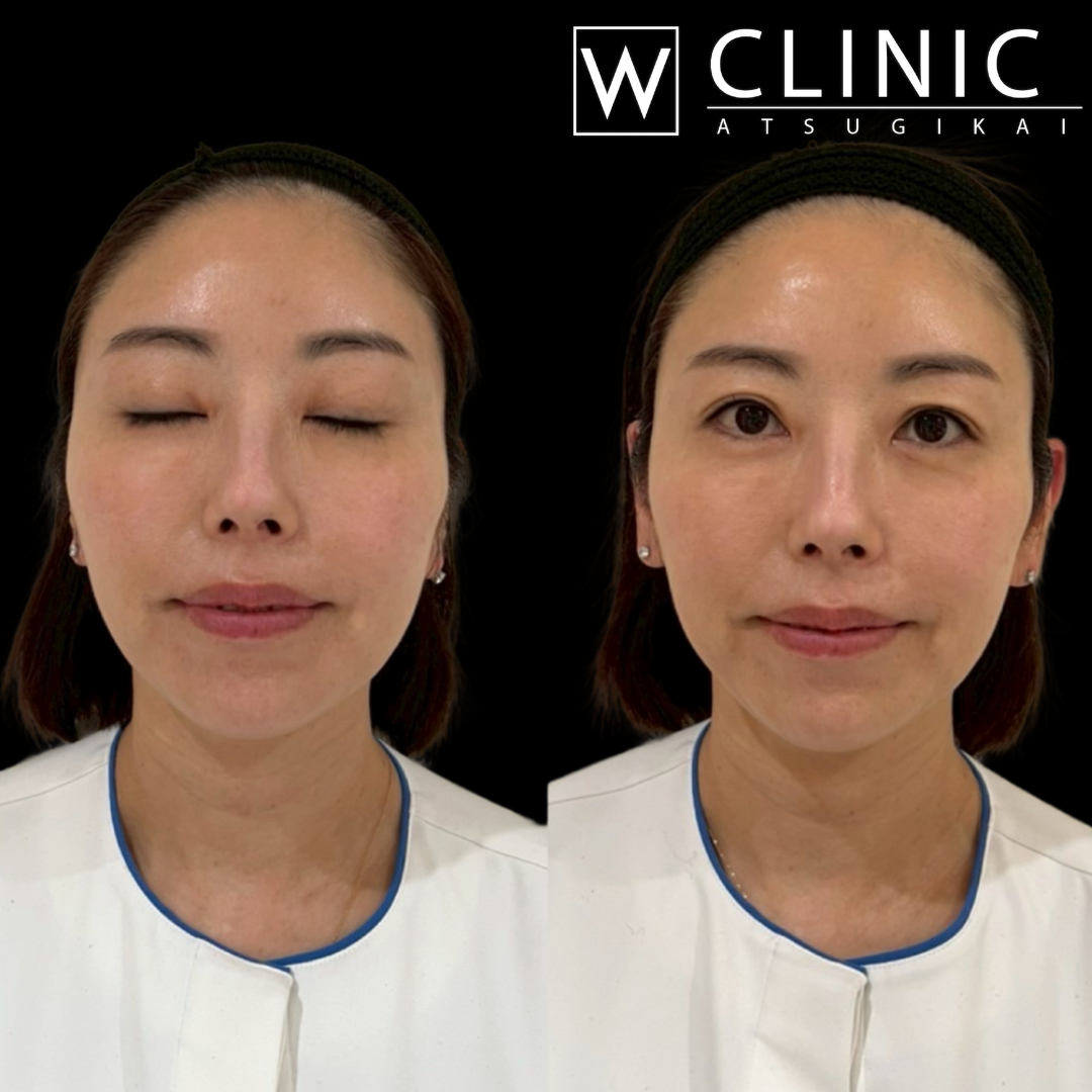 立ち耳ヒアルロン酸