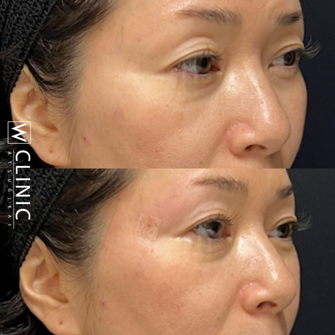 アッティバ 上瞼 施術直後